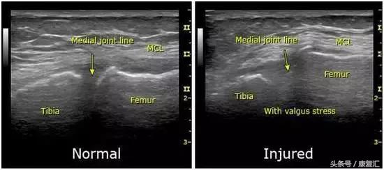 膝关节内侧副韧带损伤要多久恢复,膝关节内侧副韧带损伤如何治疗