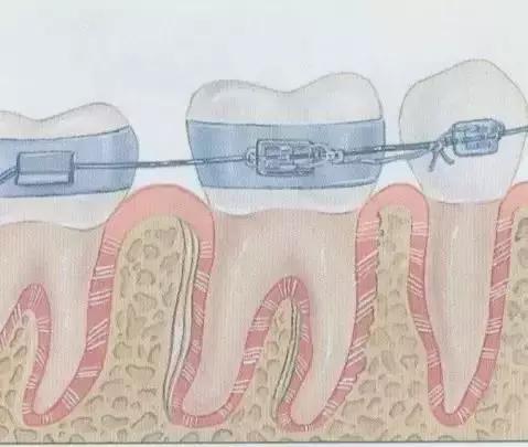 牙套上钢丝了好痛怎么办,牙套上钢丝很紧