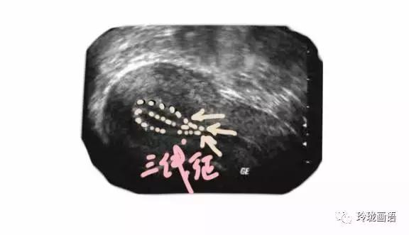 不孕和精子有关系吗,不孕主要是子宫内膜薄吗