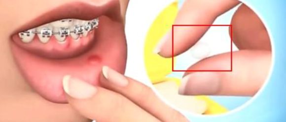矫正牙齿后经常口腔溃疡怎么办,牙齿矫正口腔溃疡最快解决方法