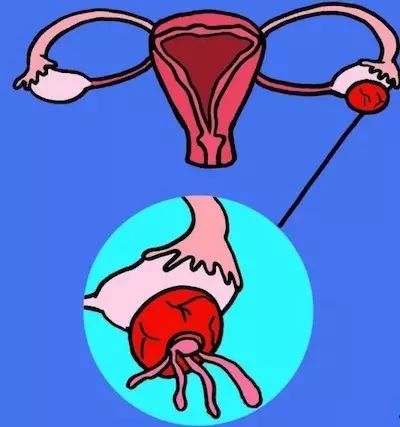 卵巢肿瘤的四种症状,卵巢实性包块的四种症状