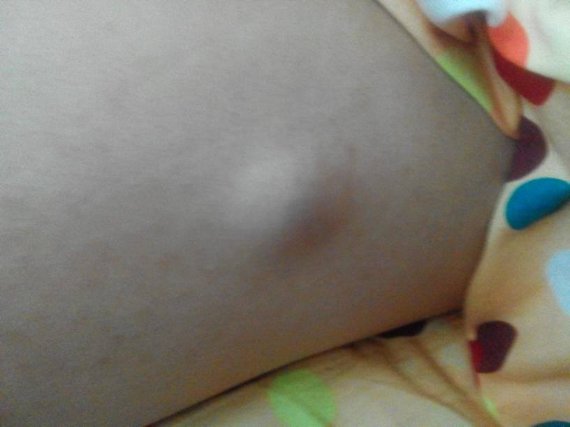 切除脂肪瘤手术要大概多少钱,乳房脂肪瘤有什么危害需要切除吗