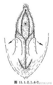 家有女儿的家长看过来,女宝外阴粘连长大了会影响吗