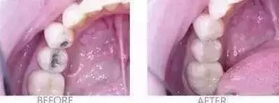 同样是补牙价格为什么差很远,同样补牙为什么报销不一样