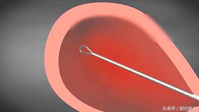 人工流产的胎儿会变成什么样,人工流产胚胎会不会活