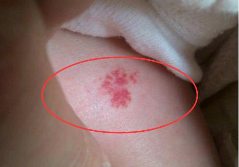 1岁宝宝腿上长一片斑,1岁宝宝腿上出小红点