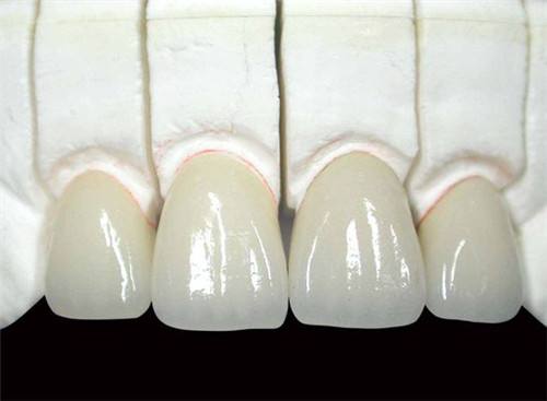 烤瓷牙连桥修复大概多少钱一颗,用烤瓷牙的方法矫正牙齿