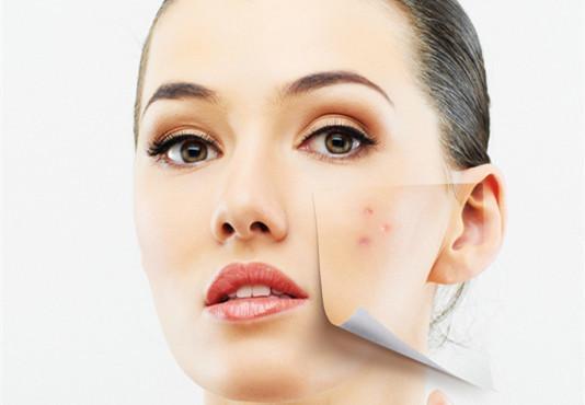 痘印一直不消除是怎么回事,痘印为什么一直消不下去