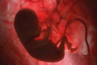 新生儿胎粪吸入综合症怎么办,新生儿胎粪吸入综合症有后遗症吗