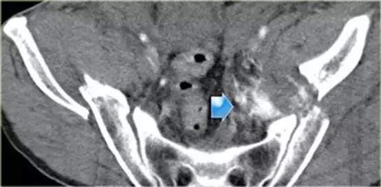 腹腔脏器炎症ct可以查出来吗,膀胱创伤的诊断方法