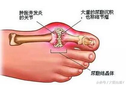 健康的脚什么形状,健康脚的重要性你知道吗