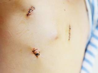 先心病可以做微创手术吗,先心病开胸和微创哪个治愈率高