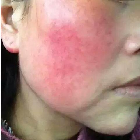 激素脸反复起红疹痒怎么办,激素脸出红疹子怎么办