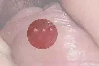 蛋蛋长痘痘?长疙瘩?当心变成“坏蛋”!