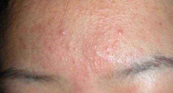 成人痘最佳治疗方法,成人痘痘不留疤痕祛除法