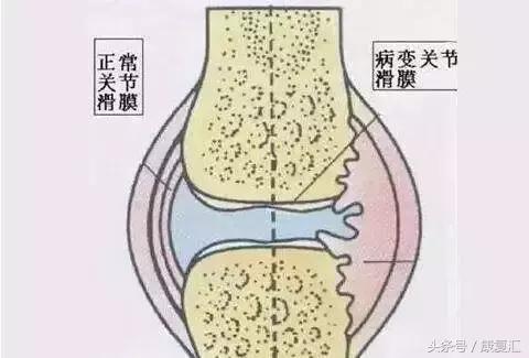 轻度慢性滑膜炎的康复锻炼,滑膜炎治疗方法和康复训练