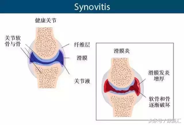 轻度慢性滑膜炎的康复锻炼,滑膜炎治疗方法和康复训练