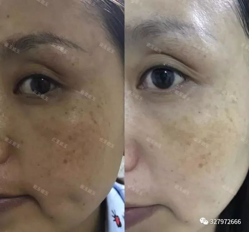 补水美白淡斑最好的方法,补水保湿美白淡斑抗皱修复