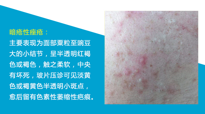 八种痘痘,九大部位的痘痘