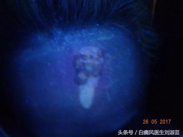 白斑患者的真实生活,白斑患者自述