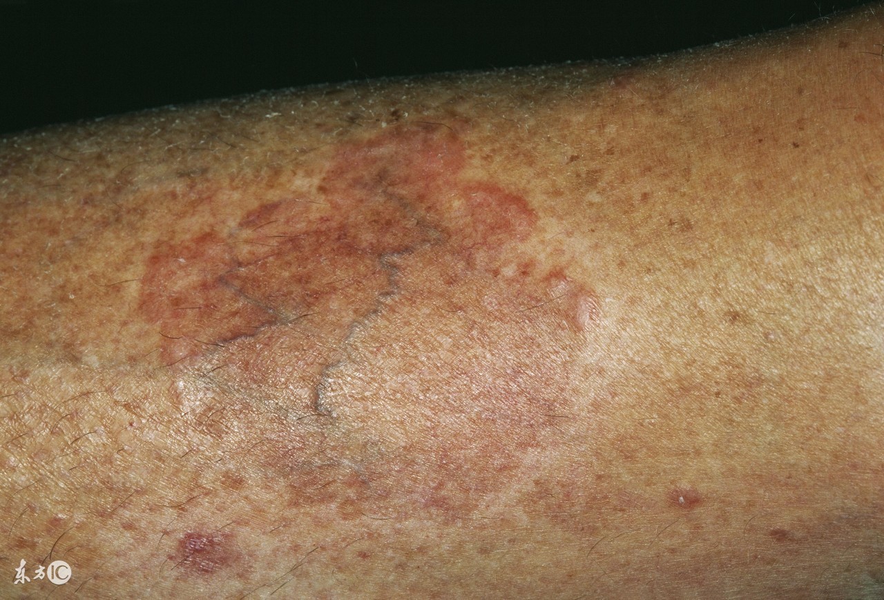 关注银翘病咨询,关注皮肤病