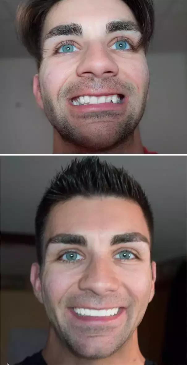 后悔整牙和不后悔整牙,整牙一般整到什么样就可以了