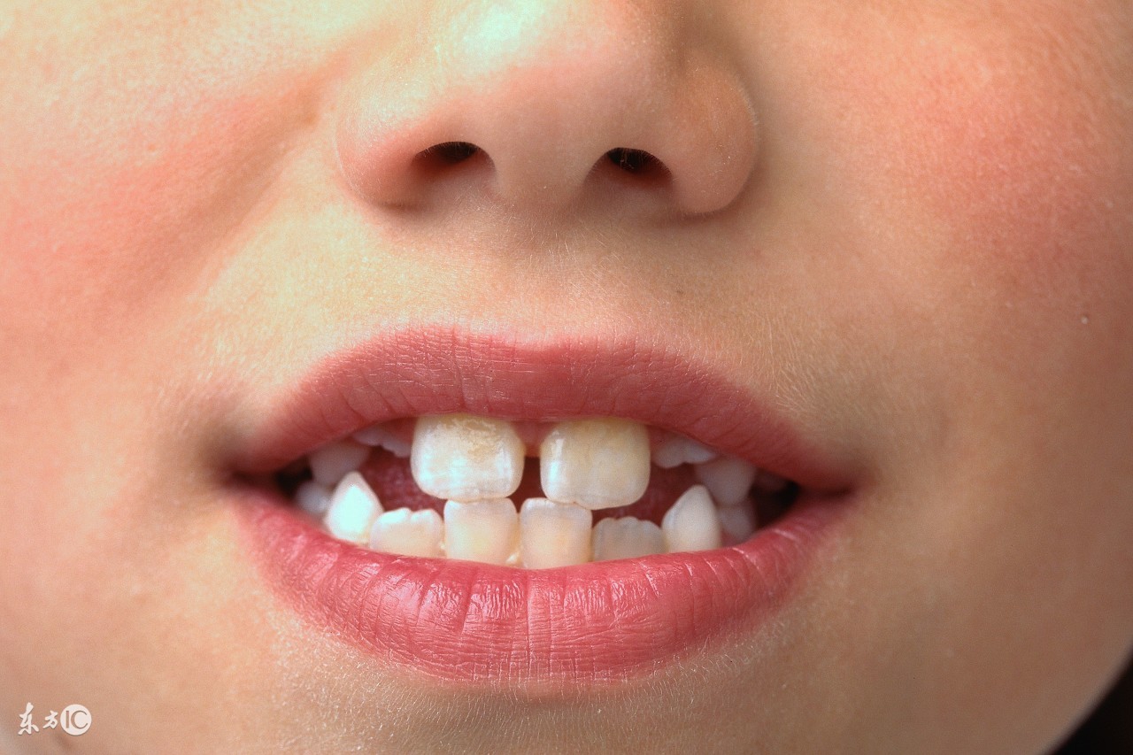 宝宝乳牙釉质发育不全怎么办,宝宝出牙期妈妈最易忽视护理细节