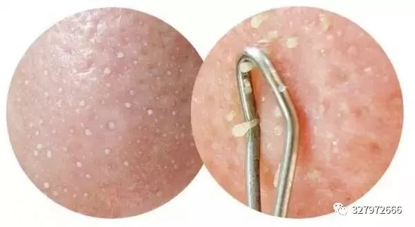 黑头痘痘粉刺去除过程护理,巨大粉刺型痘痘怎么治疗