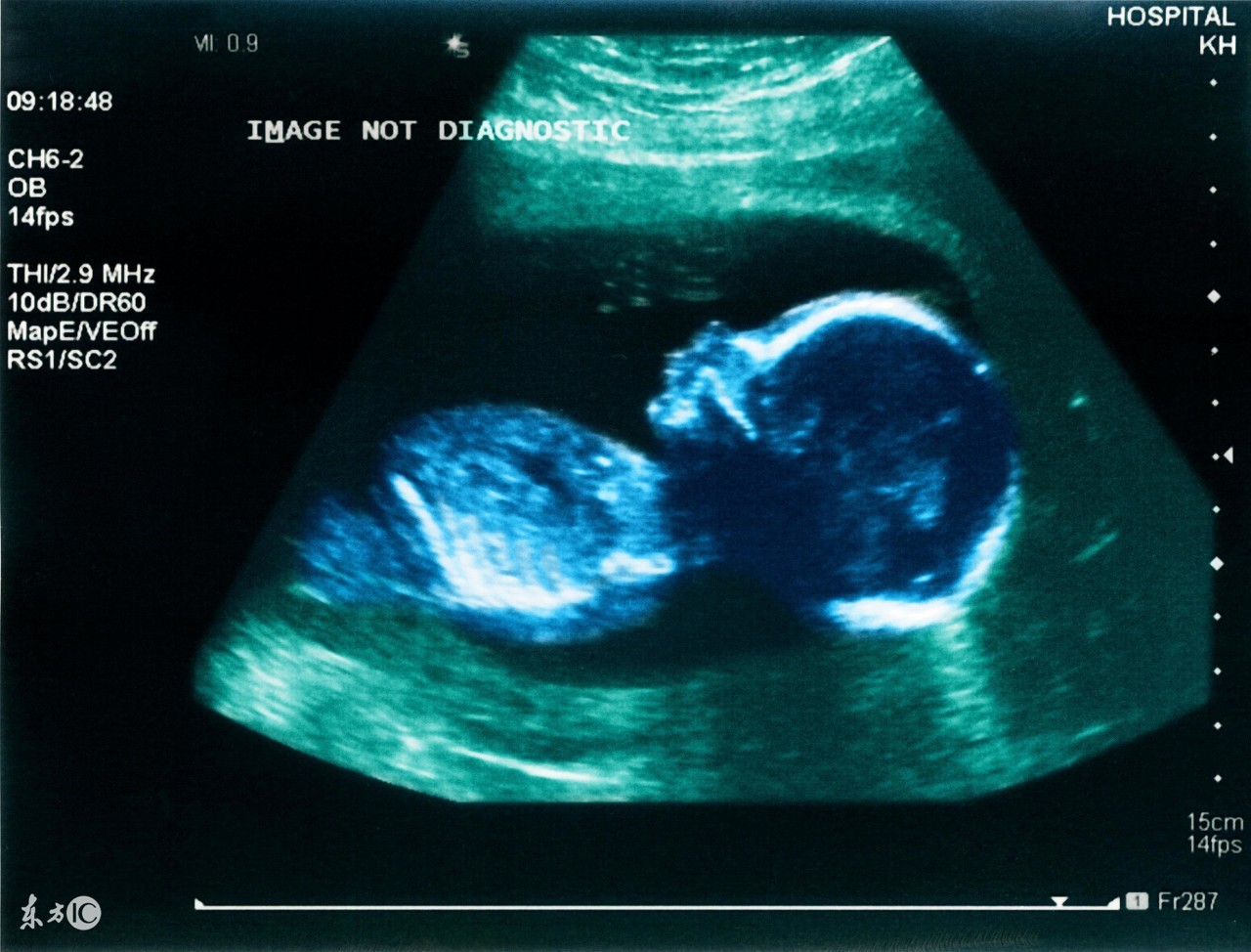 四维彩超什么时候看清胎儿模样,四维彩超的最佳时间是在孕22-24周