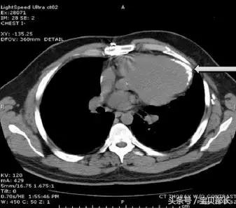打点滴时空气进了血管多少有危险,打点滴时空气进了血管会死吗