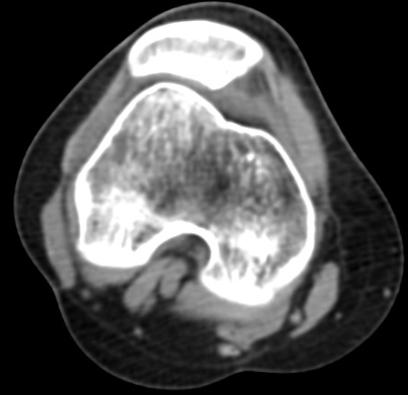 慢跑膝盖疼的恢复方法,慢跑为什么膝盖会疼