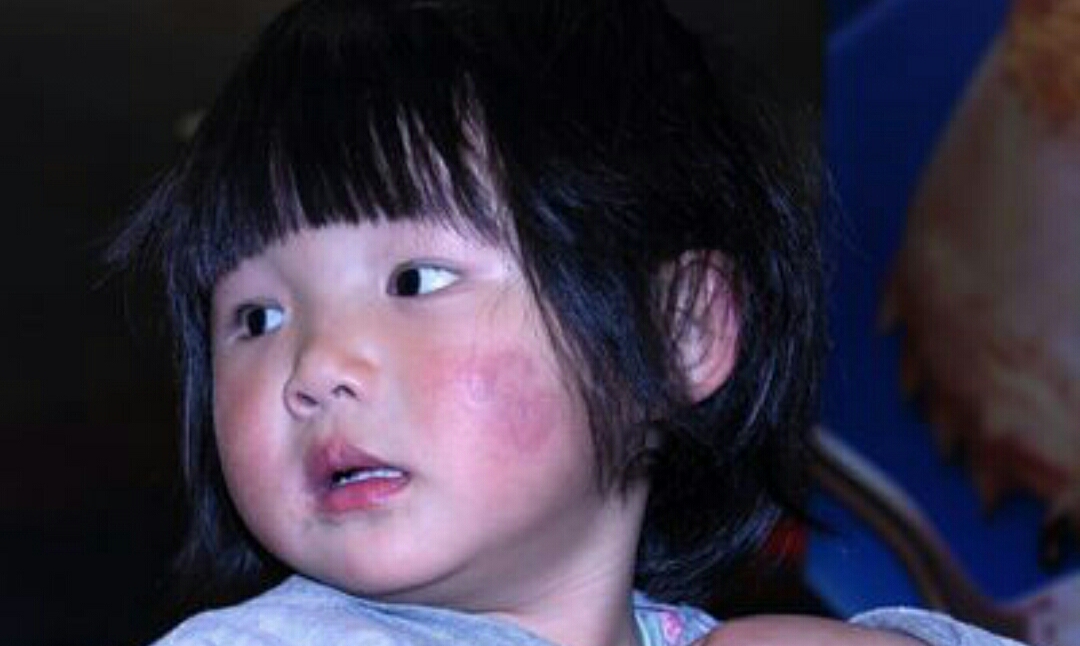 冻伤疮最佳治疗方案,冻伤疮什么意思