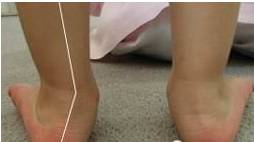 x型腿该如何改善o型腿,o型腿矫正纯干货分享