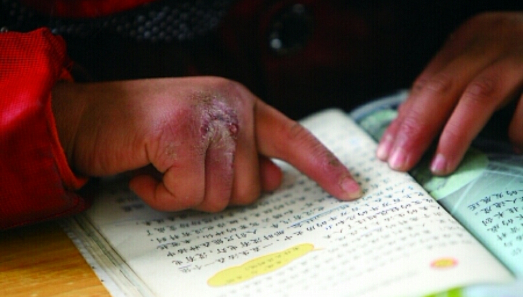 冻伤疮什么意思,手冻伤起疮最有效的方法