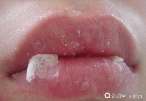 解决嘴唇干裂的小妙招,嘴唇干裂怎么缓解小妙招