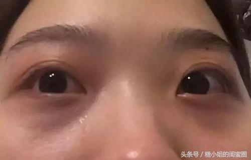 怎样拯救黑眼圈,如何才能拯救我的黑眼圈大眼袋