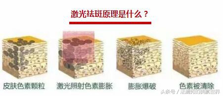 祛斑成功堪比整容,激光祛斑显老