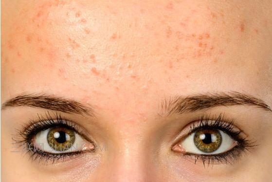 小朋友额头长痘痘怎么办,女儿额头上长痘痘怎么办