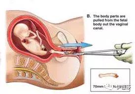 无痛人流3次会不孕吗,无痛人流花了快6千感觉被骗了