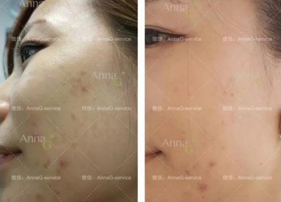 急救熬夜长痘精华,教你6招解决熬夜肌肤问题