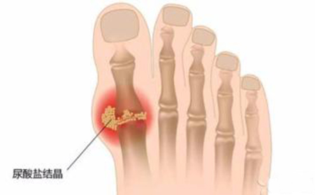 痛风食谱最不能吃的肉菜,痛风患者的一日三餐食谱大全
