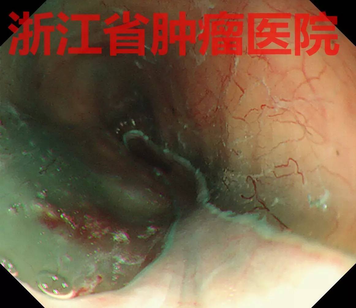 食管大面积黏膜病变,看看这家医院如何处理?!