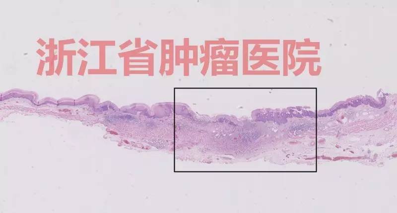 食管大面积黏膜病变,看看这家医院如何处理?!