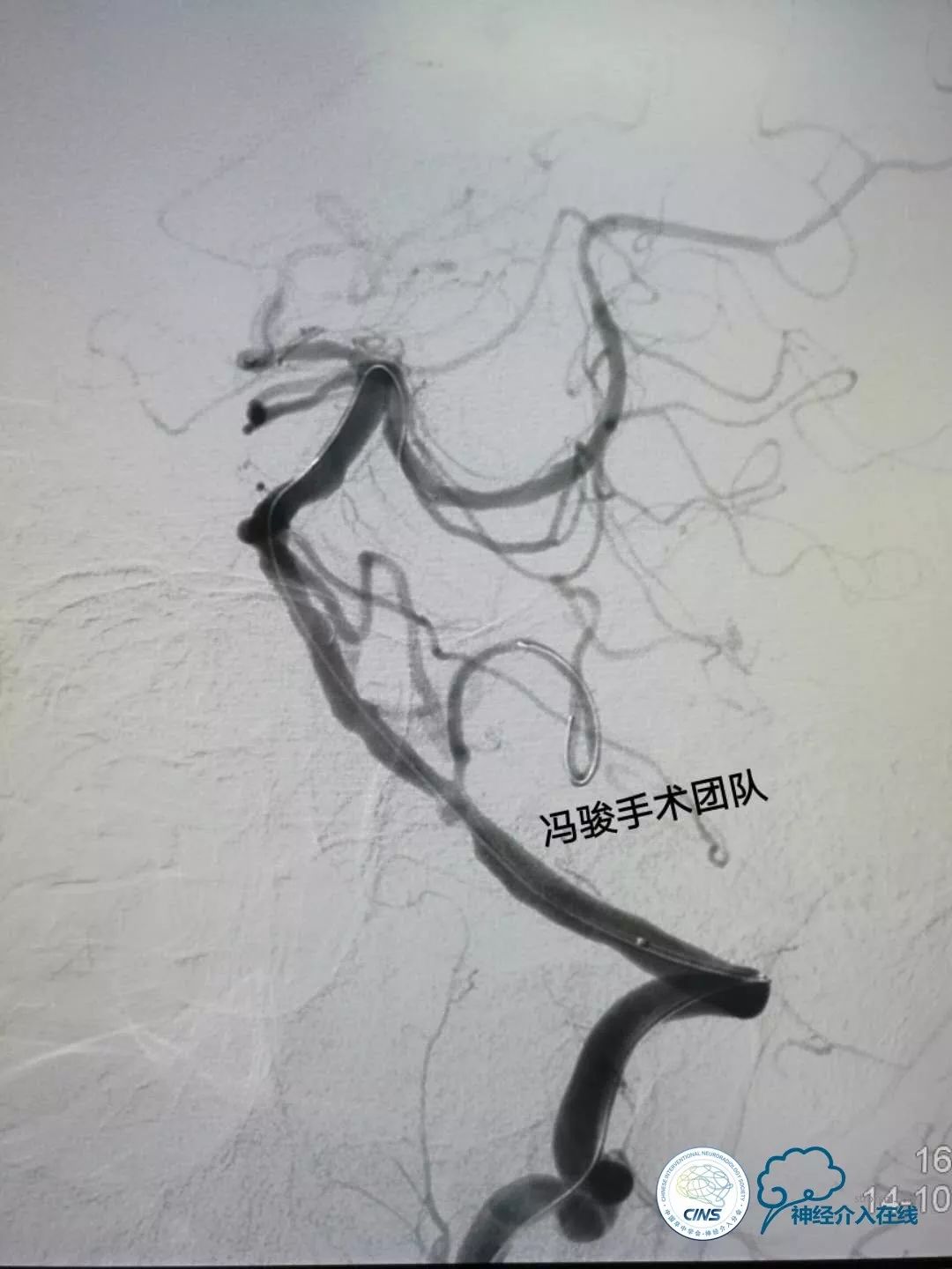 天新福—百家百言｜一例孤独椎动脉V4段并PICA重度狭窄支架手术及1年随访