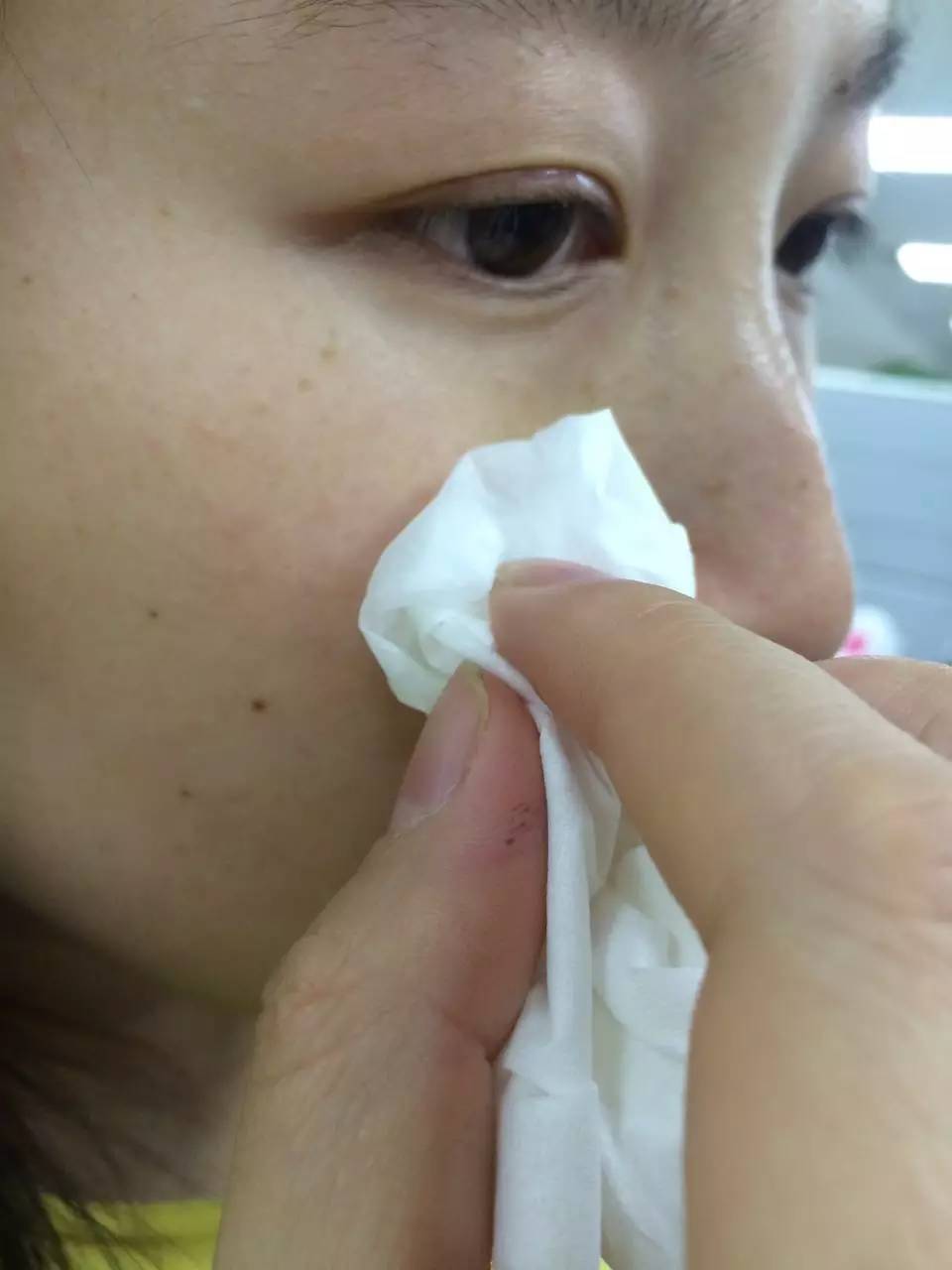 健康关注重点,哪些位置的痘不能随便乱挤