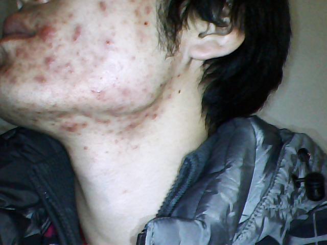 嘴巴和下巴周围长痘的原因怎么治,鼻翼两侧和下巴长痘什么原因引起