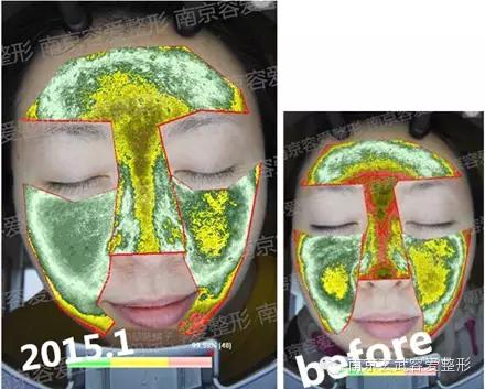 手把手教你如何抗痘,教你有效抗痘6个绝招