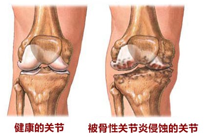 导致发生骨关节炎的最重要的原因,诱发性关节炎是怎么引起的