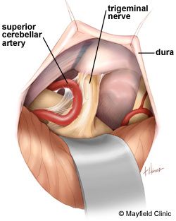 三叉神经痛和继发性的三叉神经痛,三叉神经贴治疗三叉神经痛的原理