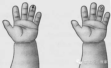 张世卿教授漫谈扁桃体的是是非非